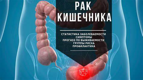 Рак кишечника. Статистика. Первые симптомы. Группы риска. Профилактика Картинка - Рак кишечника. Статистика. Первые симптомы. Группы риска. Профилактика