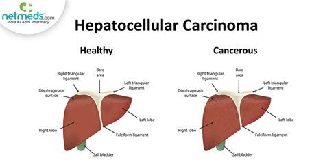 Hepatocellular Carcinoma Causes Symptoms And Treatment