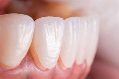 The Truth About Dental Veneers In Turkey Turkey Teeth