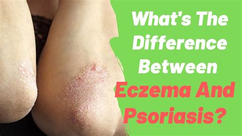 Whats The Difference Between Eczema And Psoriasis YouTube