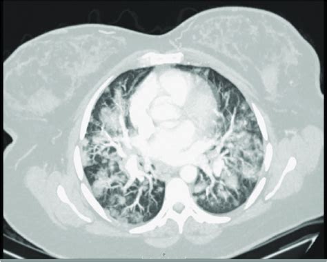 Chest Computerized Tomography Showing Extensive Severe Bilateral Focal