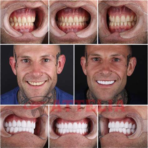 Turkey Teeth Halesowen Dental
