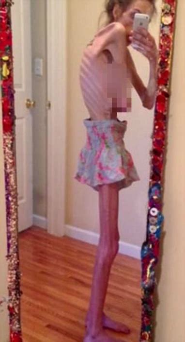 Obese To Walking Skeleton She Suffered Year Anorexia Due To