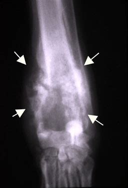 How is osteosarcoma in dogs diagnosed? Osteosarcoma - Dog