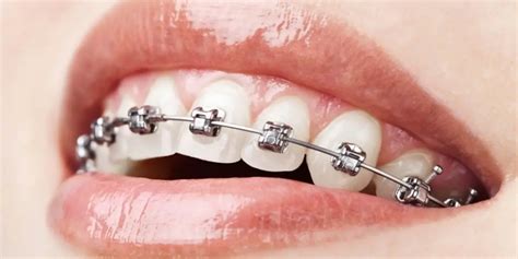 Braces Cost In South Africa 2022