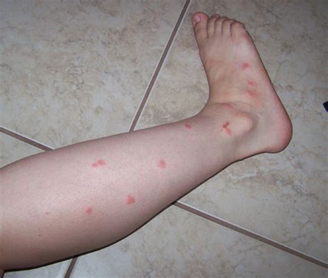 Mosquito Bites Pictures Itch Swelling Prevention And Treatment