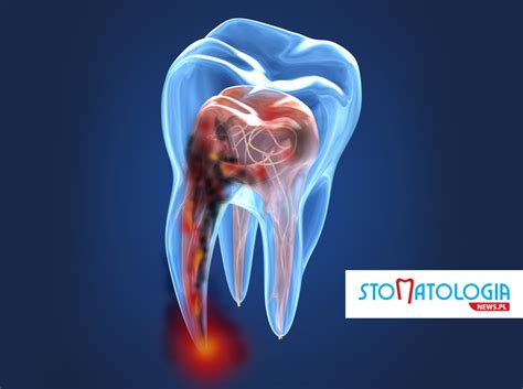 Zapalenie miazgi zęba objawy przyczyny leczenie Stomatologianews