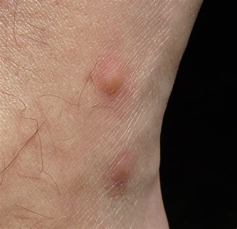 Dealing With Summer Bug Bites Midland Skin