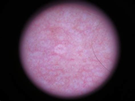 Sebaceous Gland Hyperplasia (Sebaceous Hyperplasia, Senile ...