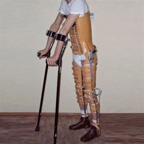 Ossur Leg Braces For Sci Or Paralysis Creative Orthotic And Prosthetic