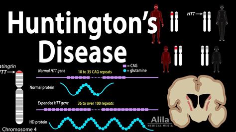 Huntington's Disease, Genetics, Pathology and Symptoms, Animation - YouTube