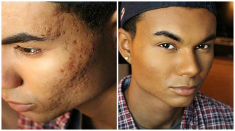 Drug Store Foundation Routine For Men Acne And Acne Scarring Coverage