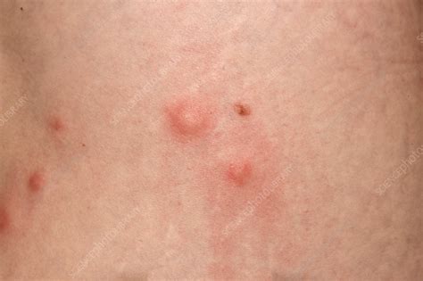 Allergic Reaction To Insect Bites Stock Image C Science