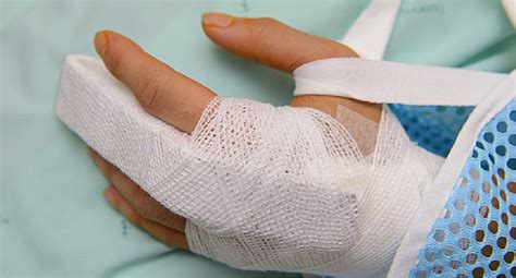Symptoms Of A Fractured Finger Northwest Broward Orthopaedics