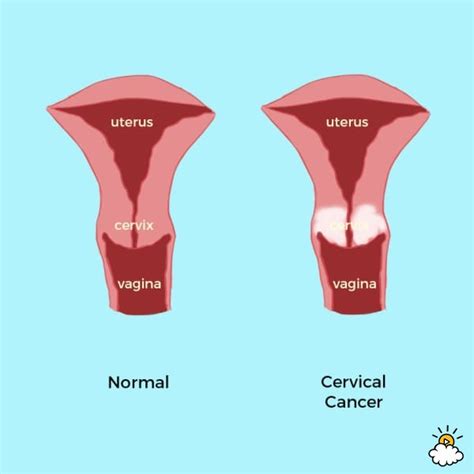 Albums 95 Background Images Signs And Symptoms Of Cervical Cancer