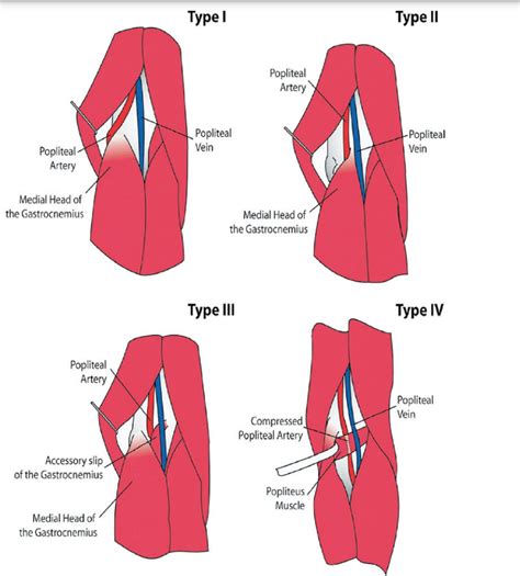 Popliteal Artery Entrapment Syndrome Sports Medicine Review