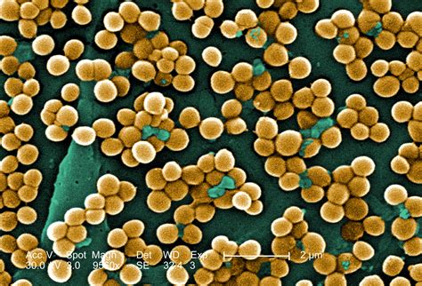 Learn mrsa infection causes, symptoms, treatment, and transmission by mrsa carriers. 5 Facts You Should Know About MRSA and Communicable ...