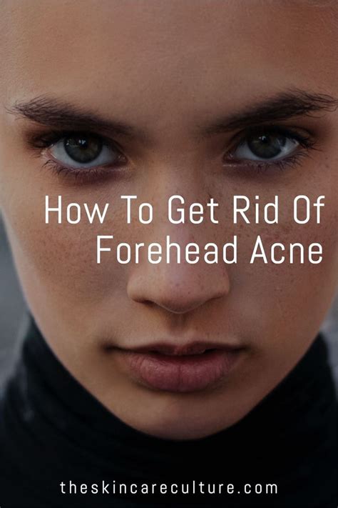 How To Get Rid Of Forehead Acne Forehead Acne Acne Forehead Bumps