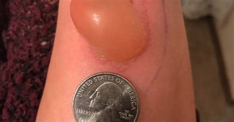 Upon close inspection, fang marks can be seen, notes webmd. Michigan woman treated for brown recluse spider bite - CBS ...