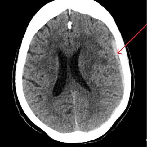 Axial View Of Computed Tomography Of The Brain Acute Subdural Hematoma Download Scientific