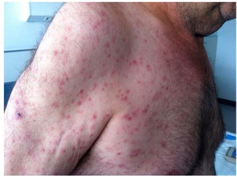 Even though typhus enters the body through cuts or scrapes on the skin, it's not just a dermatological illness. Typhus fever | Singapore | PDF | PPT| Case Reports ...