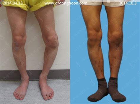 Congenital Rare Severe Leg Deformity 3 Year Post Op Limb