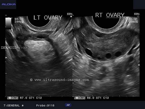 Dermoid Ovary Ultrasound Ultrasound Sonography Diagnostic Medical