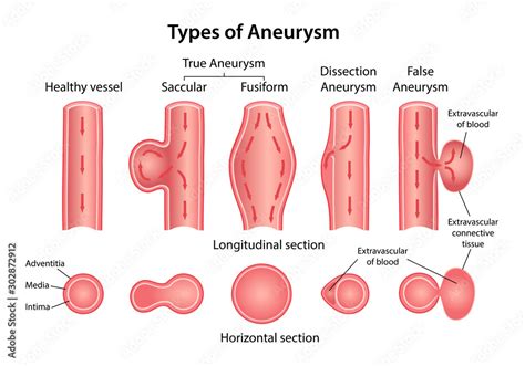 Vettoriale Stock Types Of Aneurysm True Aneurysm Saccular Fusiform False And Dissection
