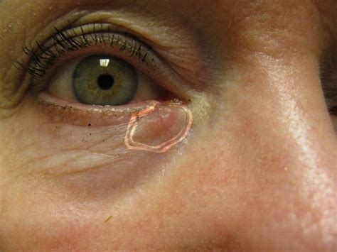 Lower Eyelid Cancer Reconstruction