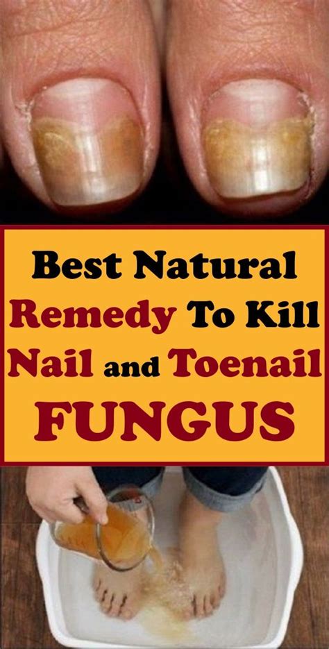 What Kills Fungus In Toenails