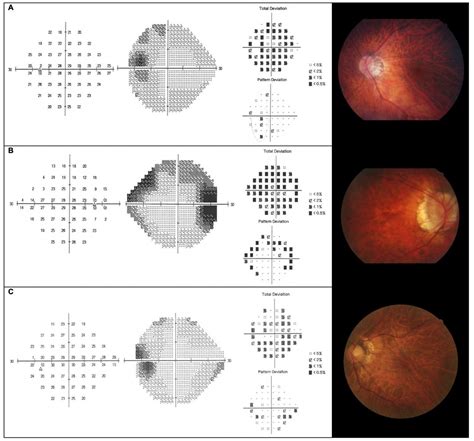 Visual Field Defects And Myopic Macular Degeneration In Singapore