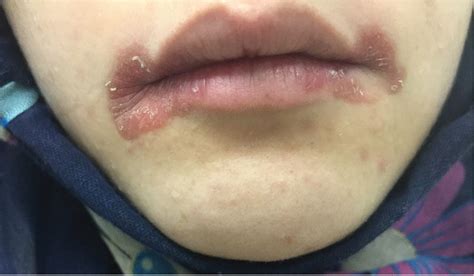 Angular Cheilitis Induced By Iron Deficiency Anemia Cleveland Clinic
