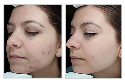 Dealing With Difficult Acne Forever Clear Bbl Could Help Dy