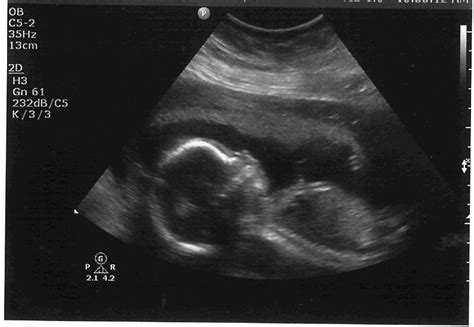 Ultrasound pictures of twins provide that intriguing first glance at multiple life in the womb. The Starr Family Blog: Baby Boy Ultrasound