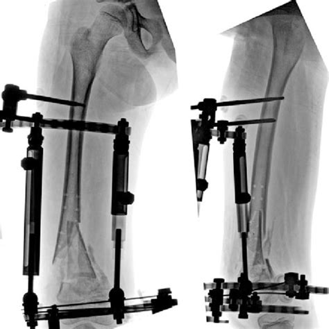 Postoperative Ap And Lat Radiographs Of The Femur After Conversion To