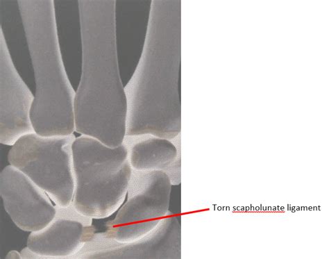 Radial Sided Wrist Pain The Scapholunate Ligament Injury Mount