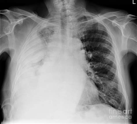 Sensitivities recorded were 41%, 51%, 36% and 56% respectively. Mesothelioma Lung Cancer, X-ray Photograph by Science ...