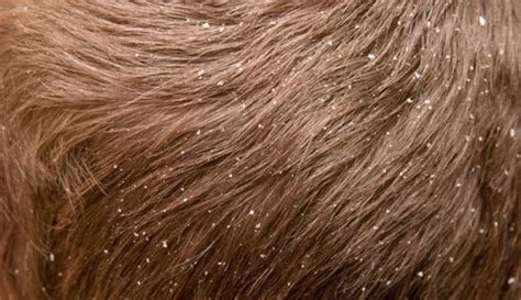 Scalp And Hair Disorders Part 1 And 2 Flashcards Quizlet