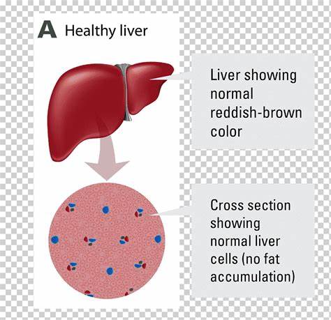 Неалкогольная жировая болезнь печени Алкогольная болезнь печени, печени Картинка - Неалкогольная жировая болезнь печени Алкогольная болезнь печени, печени