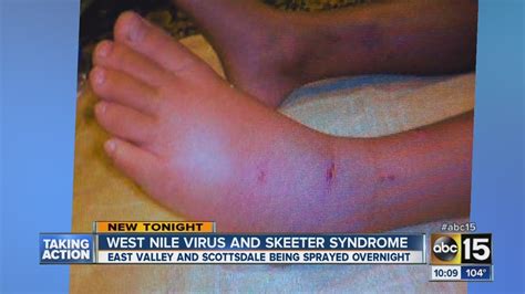 Protecting Kids From Skeeter Syndrome And West Nile Virus Youtube