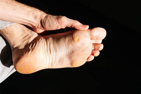 Fungus On The Foot Of The Foot A Close Up Photograph Of A Male Foot Stock Image Image Of