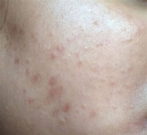 How Can I Get Rid Of Comedonal Acne White Comedones Small Bumps On