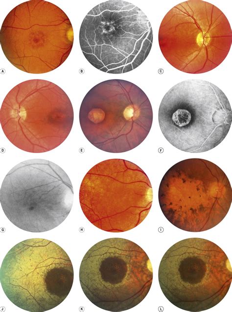 Heredodystrophic Disorders Affecting The Pigment Epithelium And Retina