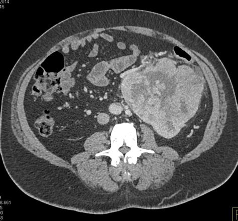Clear Cell Renal Cell Carcinoma Kidney Case Studies Ctisus Ct Scanning