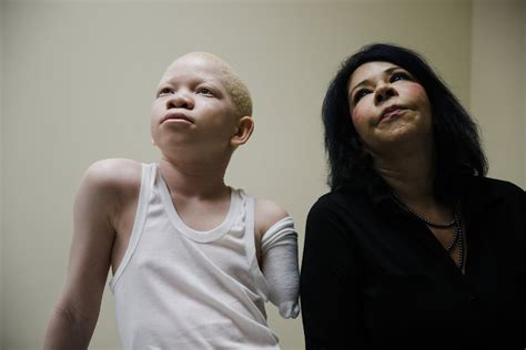 Albino Children Mutilated In Tanzania Get New Limbs In Us Ap News