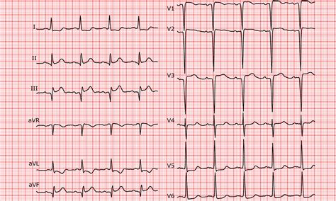 Cardio Fr Sequelae Of An Anterior Infarct And Inferior Stemi