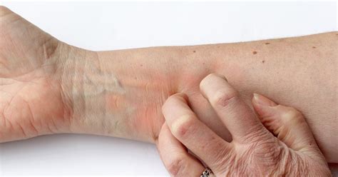 What Are The Causes Of Sudden Skin Itching Livestrongcom