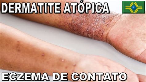 Dermatite AtÓpica Eczema De Contato O Que É Como Tratar Youtube