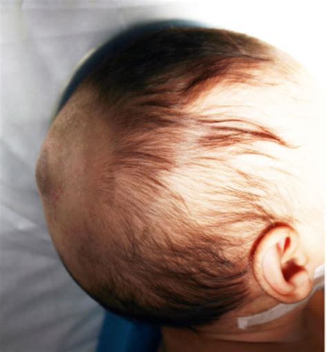 Evaluation Of Atretic Encephaloceles In Children The Ispn Guide To