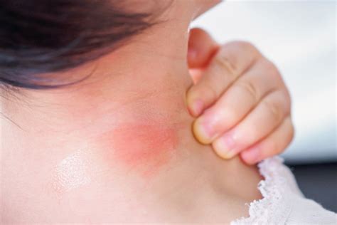Common Toddler Skin Rashes Part 1 Ovia Health